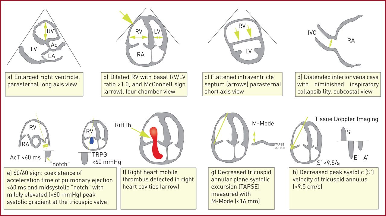 POCUS-löydökset keuhkoemboliassa